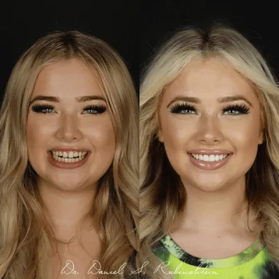 Before and after smile makeover at Bensonhurst Dental in Brooklyn: young woman, straighter and whiter teeth