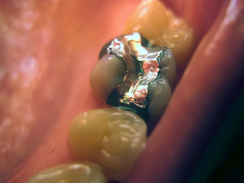 Close-up of an old silver amalgam filling in a molar